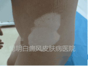 男孩侧髂部白斑两年,在我院成功康复