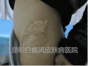 男孩侧髂部白斑两年,在我院成功康复