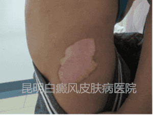 男孩侧髂部白斑两年,在我院成功康复